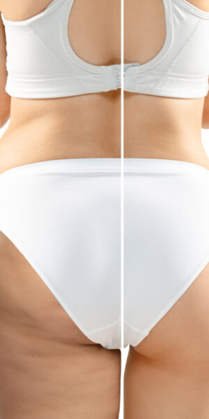 Fettabsaugung - Liposuction